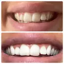 photo of before after teeth whitening