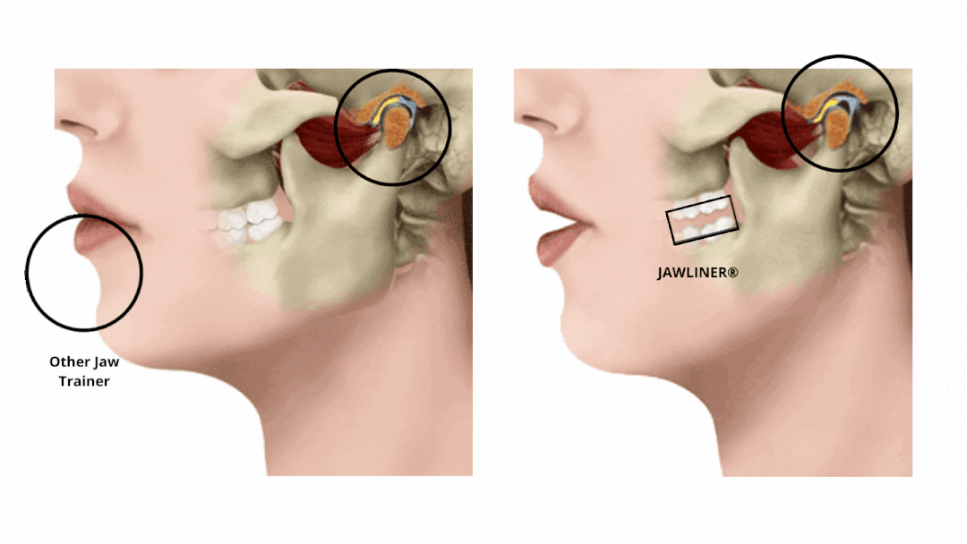 Jaw Exerciser Muscler Machoire Gomme Machoire Musculation Jaw Train