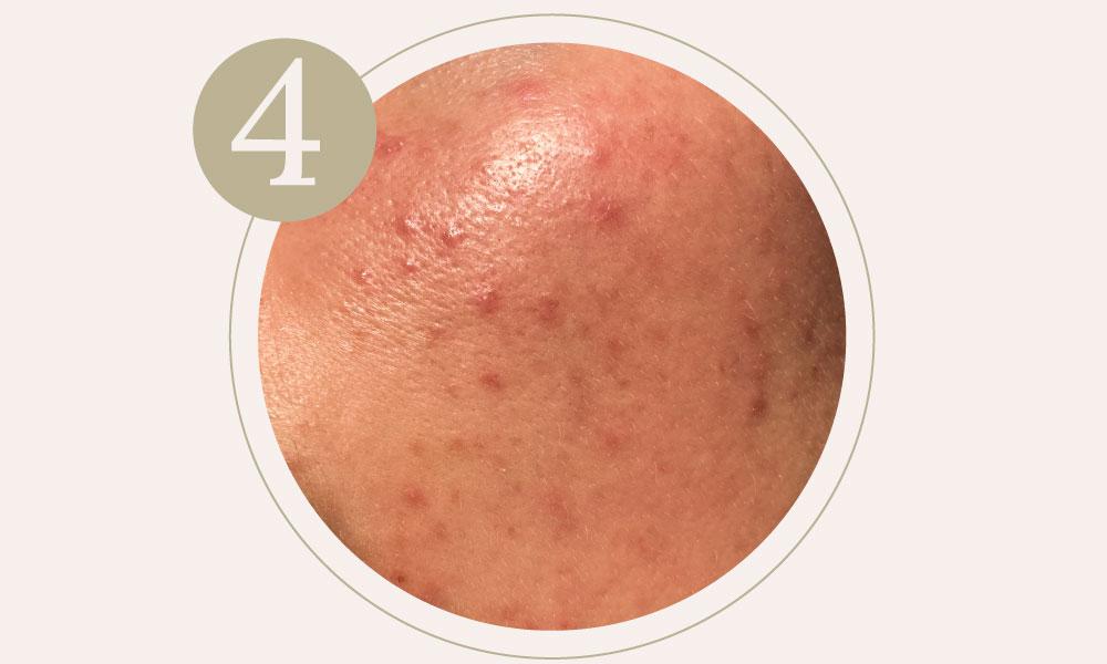 Redness on the skin