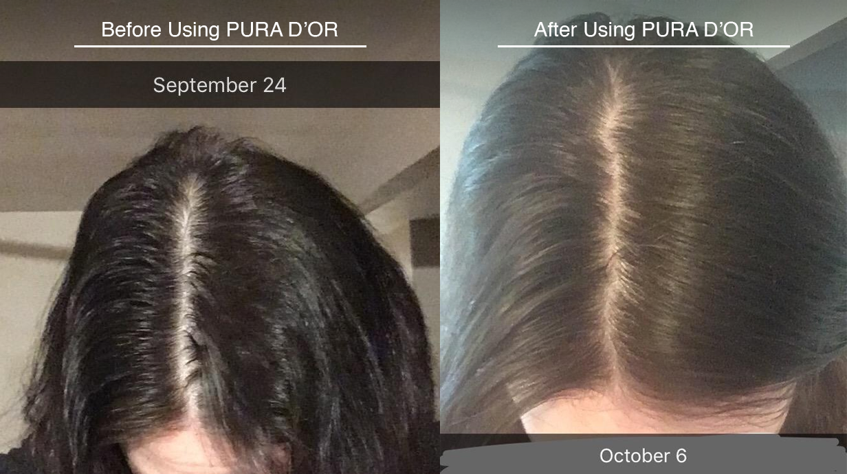 Before and After comparison using Pura D'Or. Before, dated September 24, shows a woman's hair with noticable thinning, stringyness, and oily appearance. After, dated October 6, shows the same woman's hair with thicker volume and healthy shine.