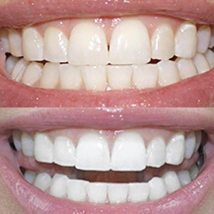 Polar MD Teeth Whitening Kit