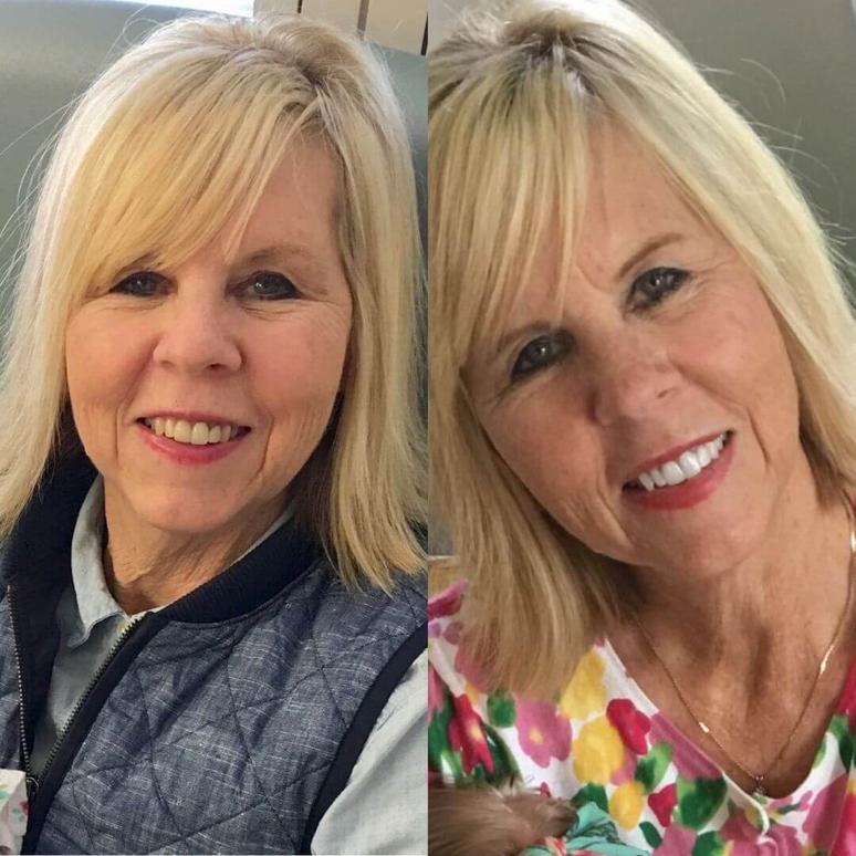 Teeth Whitening Kit Diamond Beauty Company