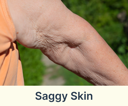 saggy skin