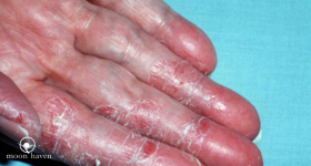 Irritant Contact Dermatitis OR Don’t Use A Body Wash If You Have Sensitive Skin