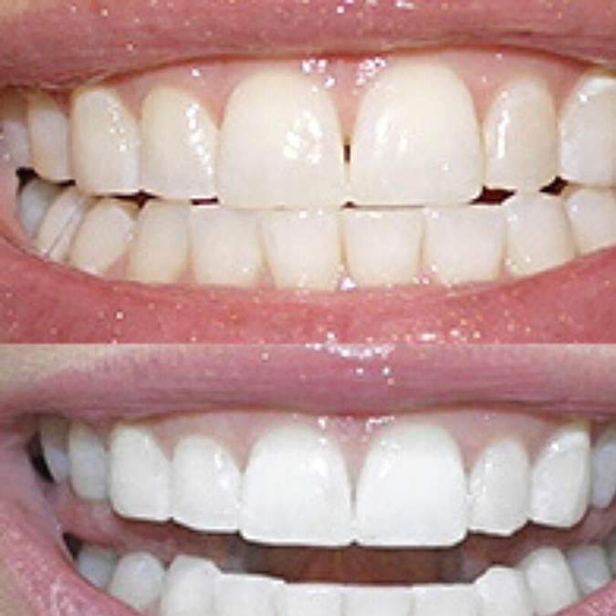 Polar MD teeth whitening