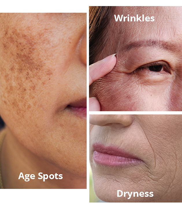 Age spots, wrinkles and dryness