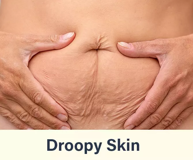 droopy skin
