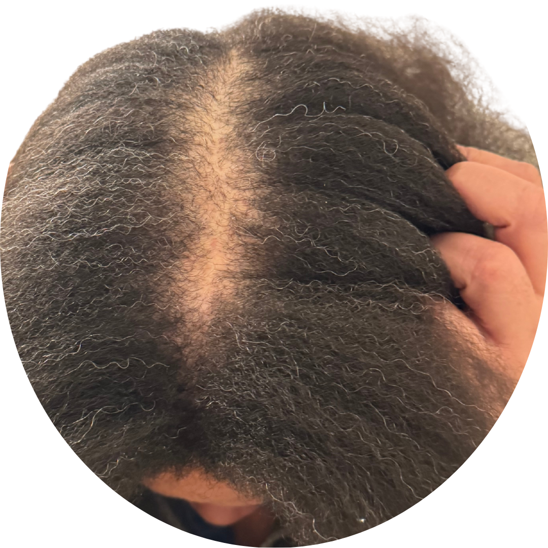 Angela's after, CCCA diagnosis