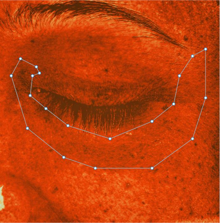 Under eye pigmentation after using toneq