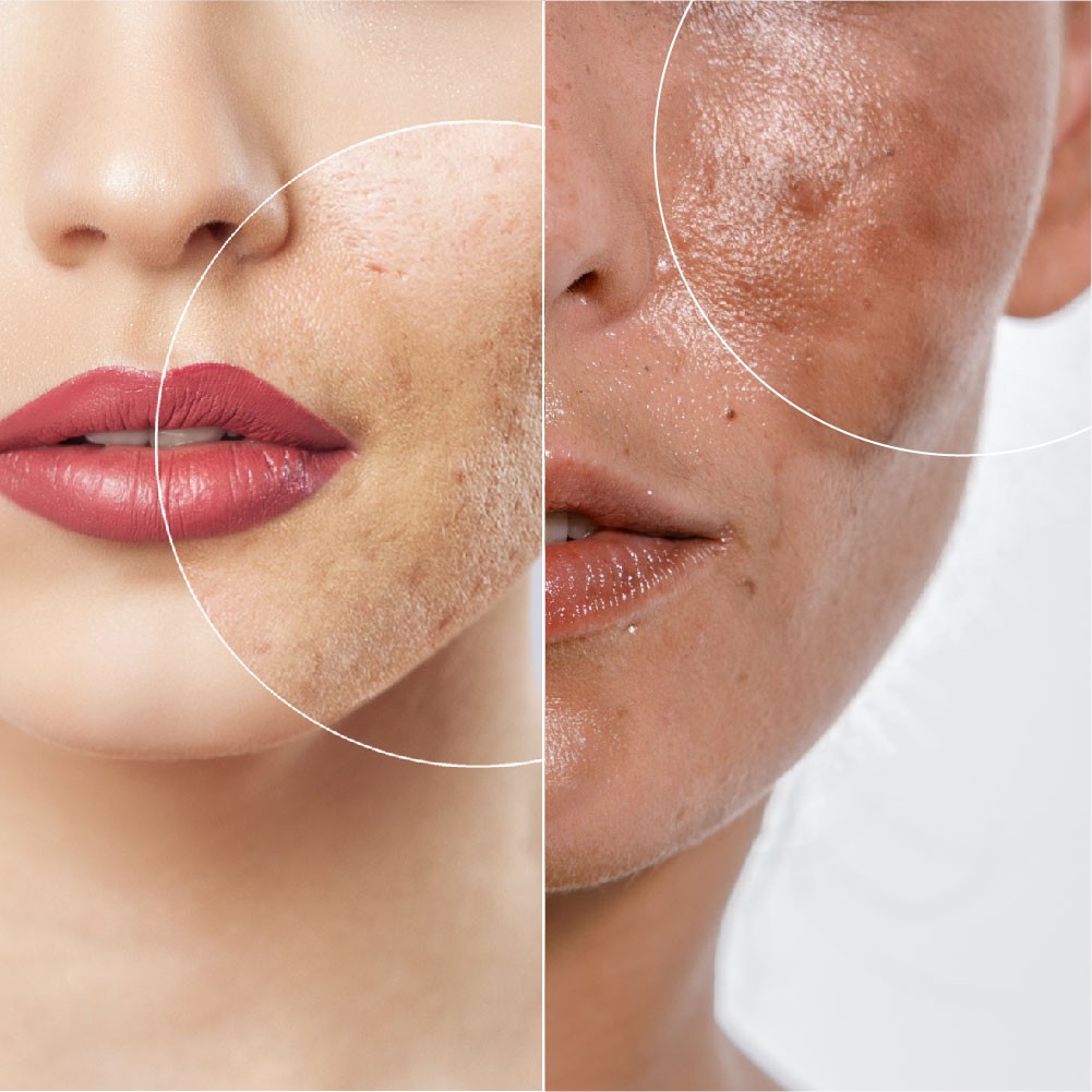 acne scars VS pigmentation