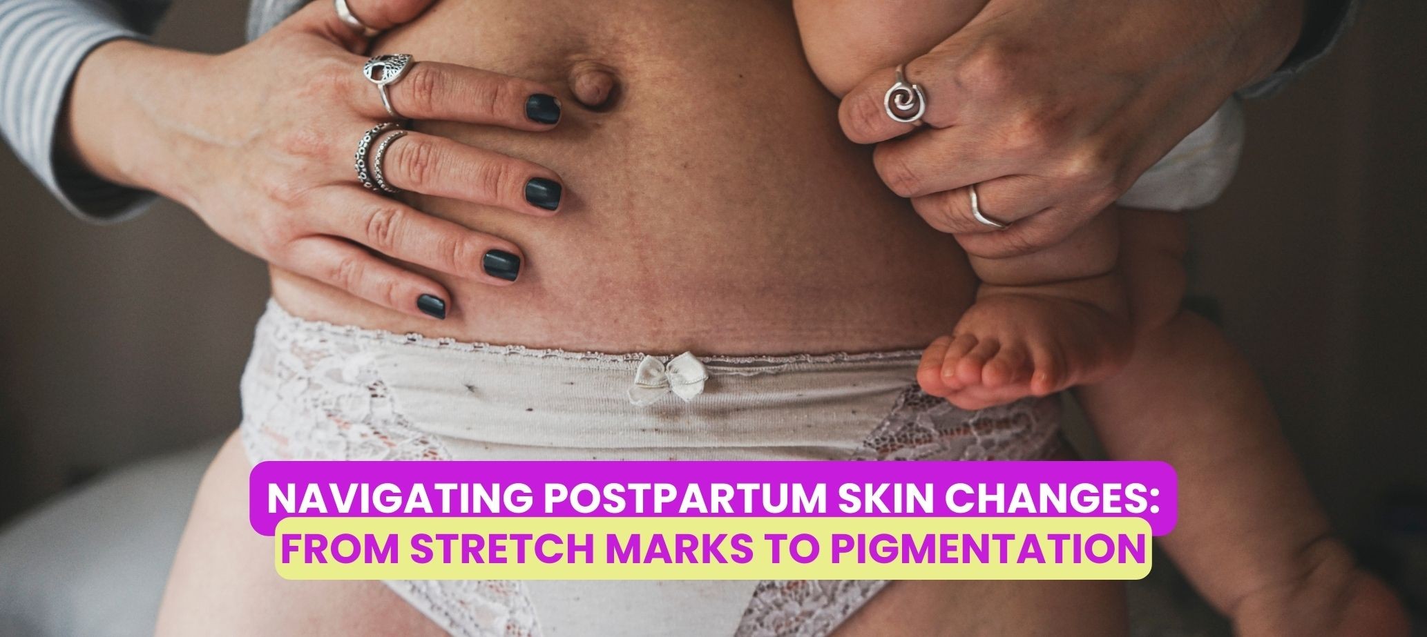 Navigating Postpartum Skin Changes: From Stretch Marks to Pigmentation