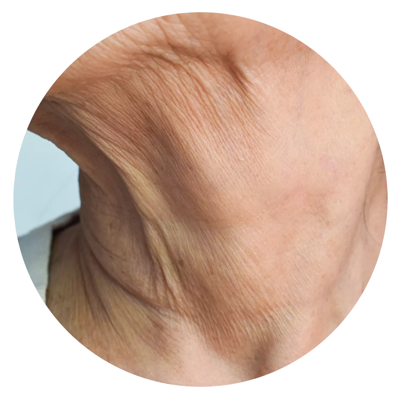 Crepey Skin
