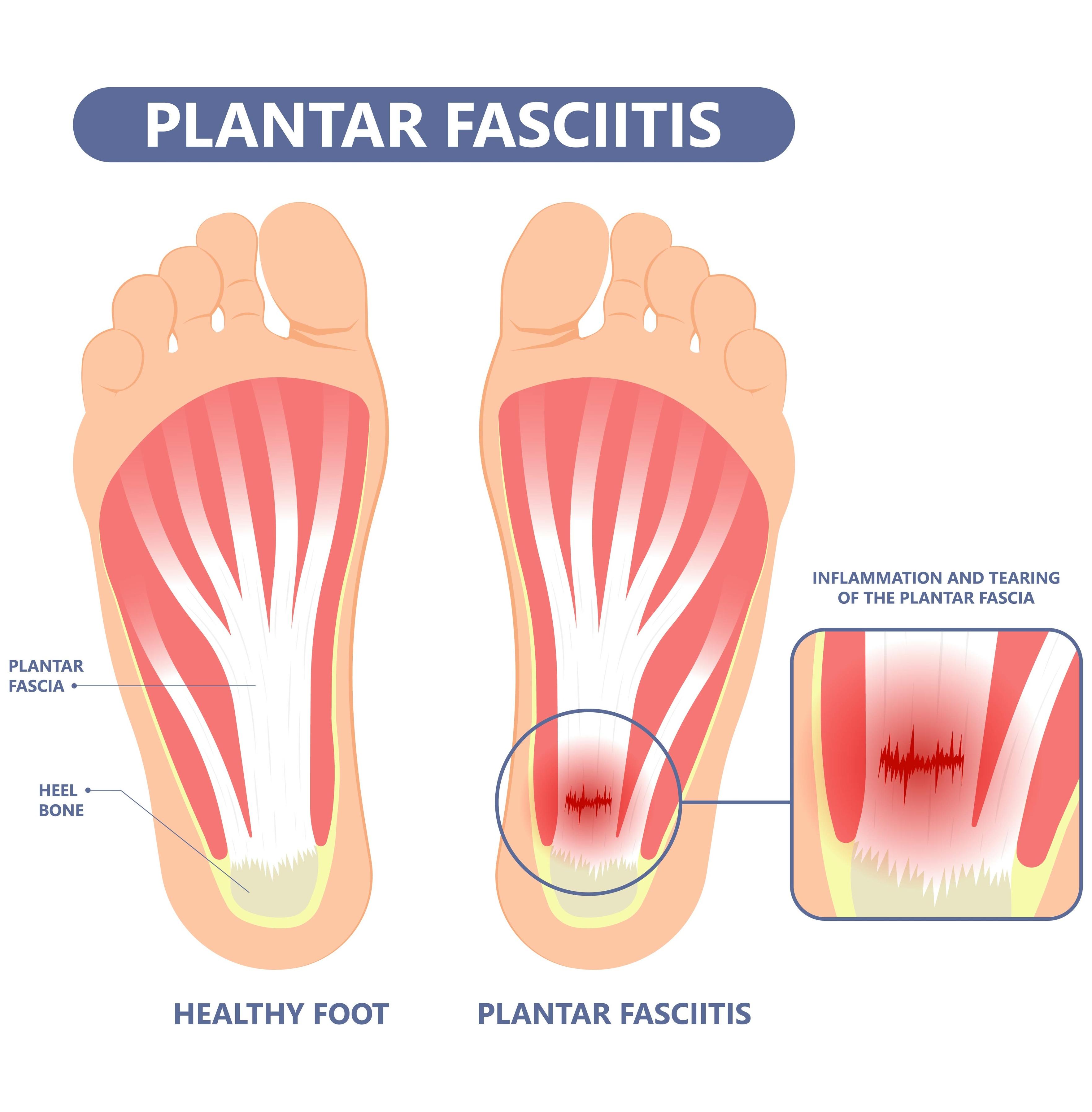 a diagram explaining inflammation that occurs from plantar fasciitis