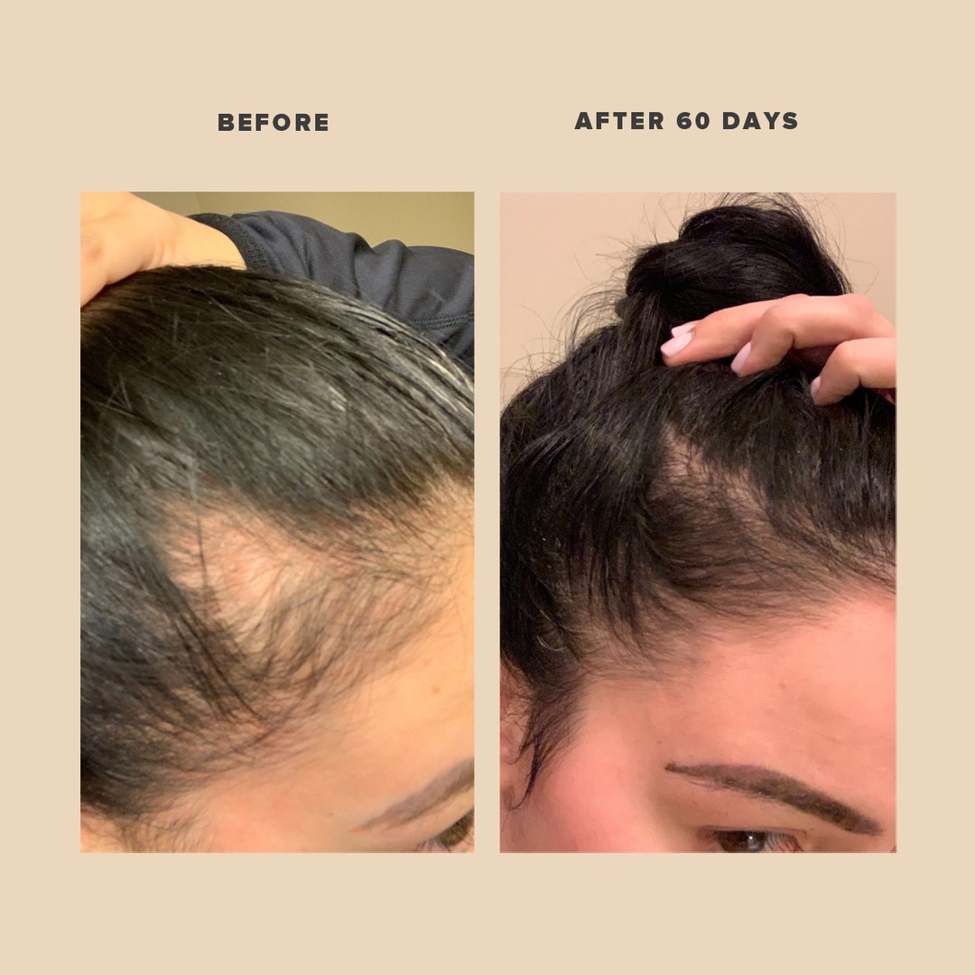 Postpartum Hair loss: How to stop it and regrow your hair!
