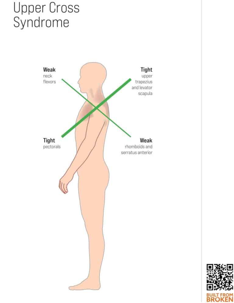 upper cross syndrome and injury risk saltwrap