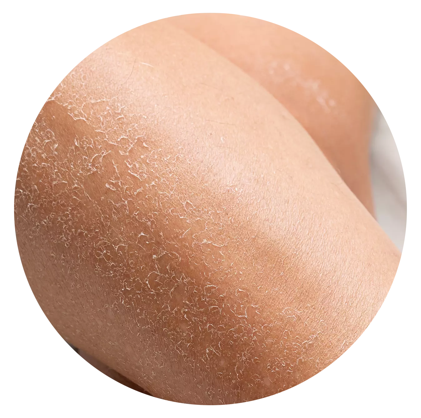 Dryness and Dehydration