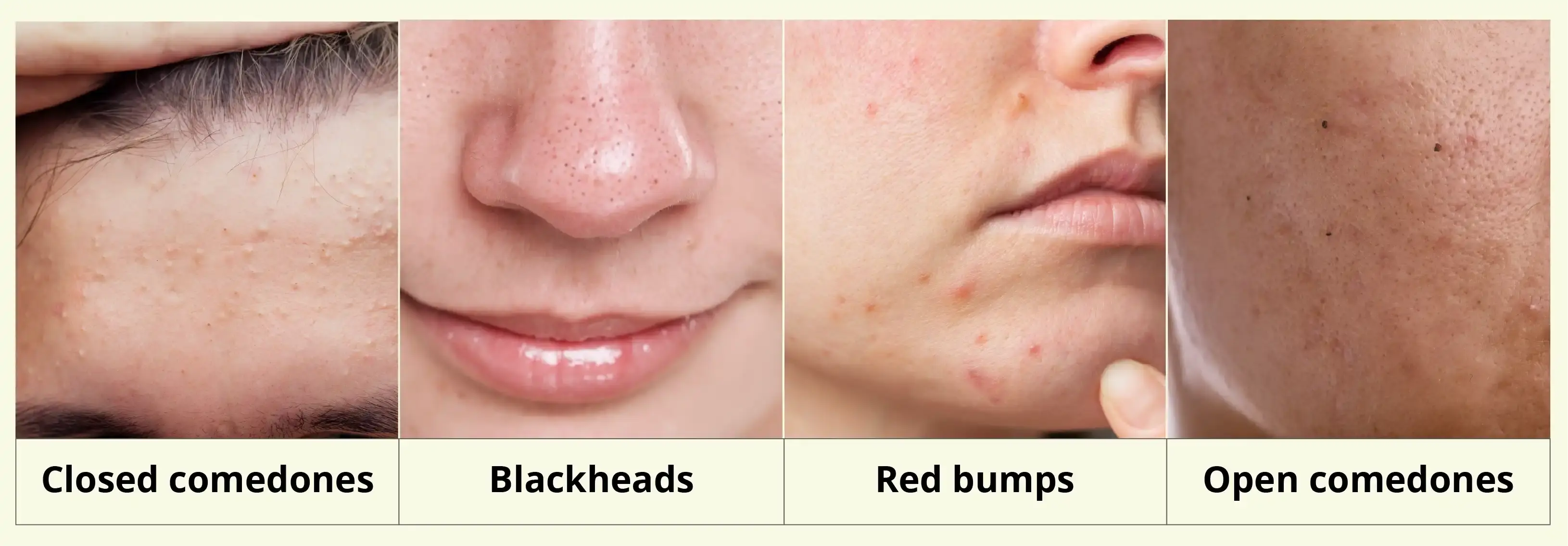 different type of Comedones